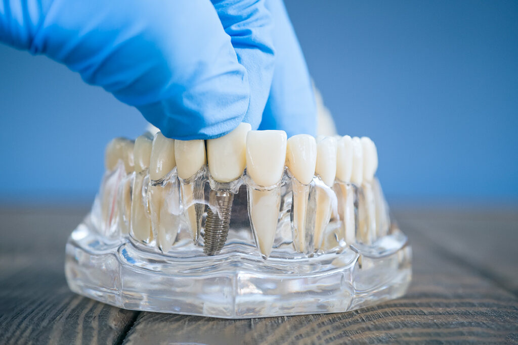 Implant jedynki, czyli jak poradzić sobie z utratą przedniego zęba?